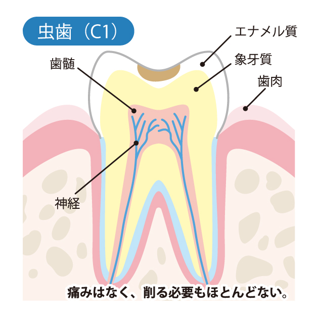 亀有の歯医者、西川クリニック歯科室｜矯正歯科のむし歯治療