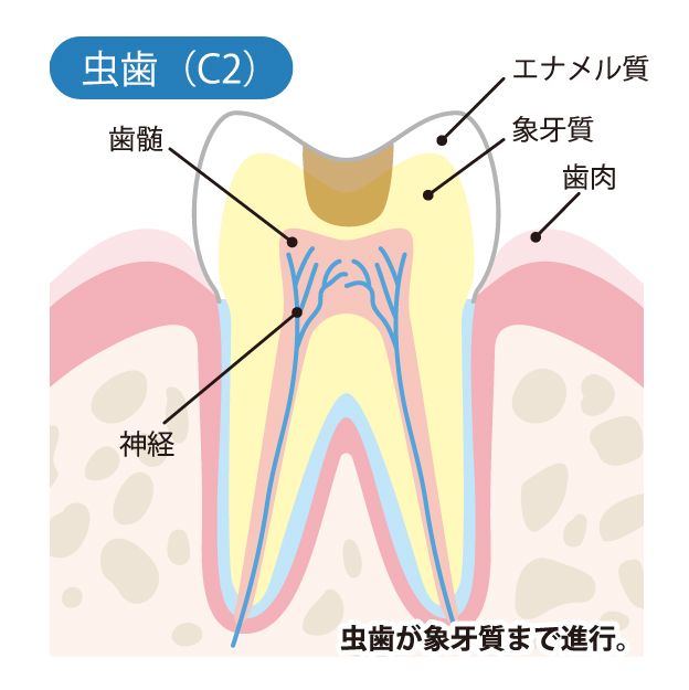 亀有の歯医者、西川クリニック歯科室｜矯正歯科のむし歯治療