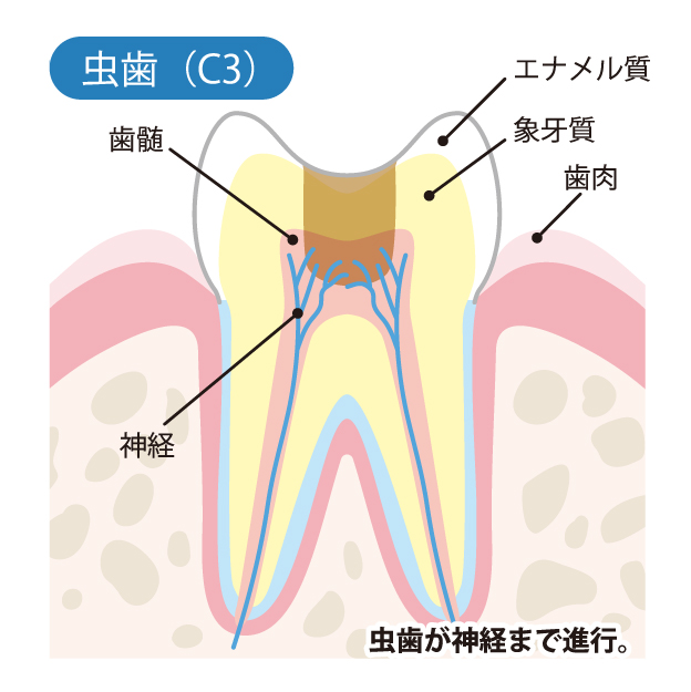 亀有の歯医者、西川クリニック歯科室｜矯正歯科のむし歯治療