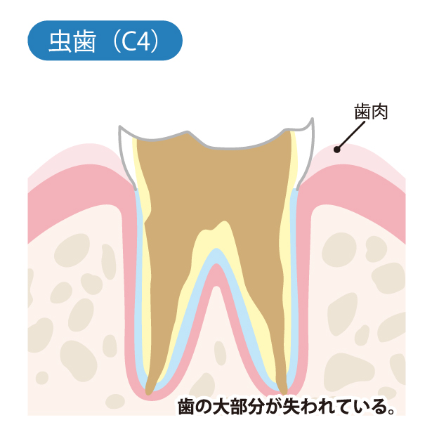 亀有の歯医者、西川クリニック歯科室｜矯正歯科のむし歯治療