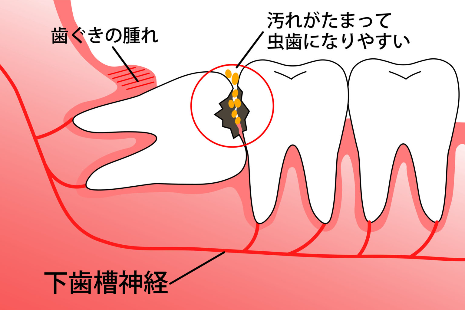 亀有の歯医者、西川クリニック歯科室｜矯正歯科の親知らずの抜歯